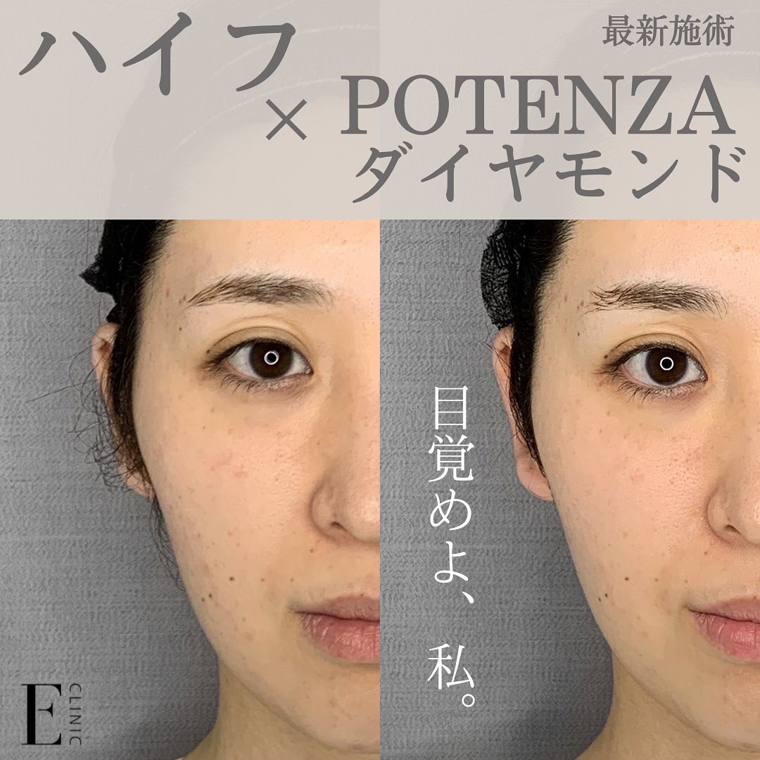 組み合わせ最強！HIFU×POTENZAダイヤモンドテップ】 - 美容皮膚科イー