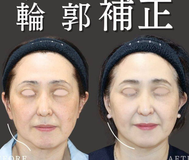 【輪郭のゆがみ補正症例】