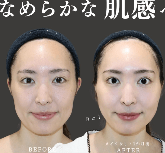 【引き締め糸リフトでなめらかな質感へ】