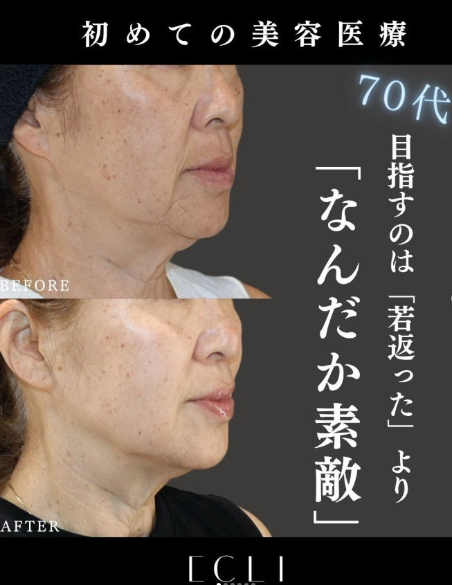 【70代｜初めての美容医療】