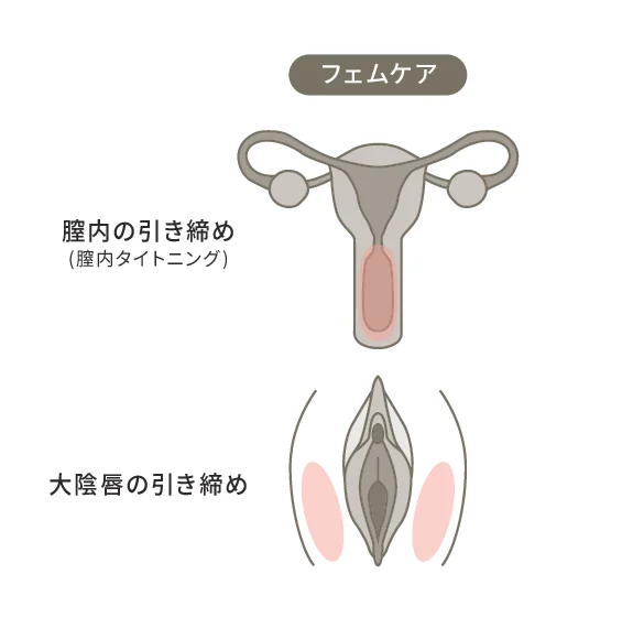ATTIVAフェムケアの治療部位:膣内・大陰唇