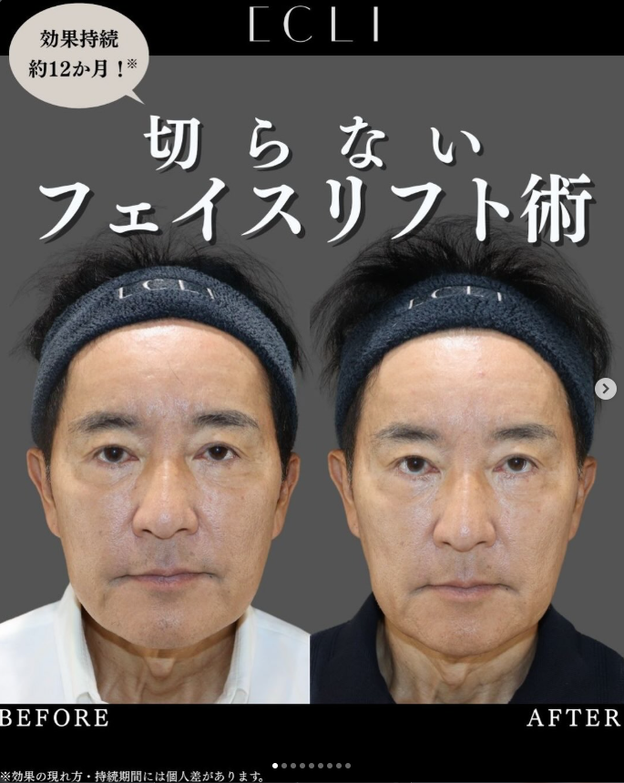 【NEW｜切らないフェイスリフト術 「ATTIVA」　院長限定】